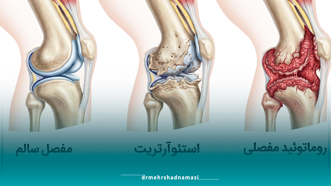 درمان استئوآرتریت