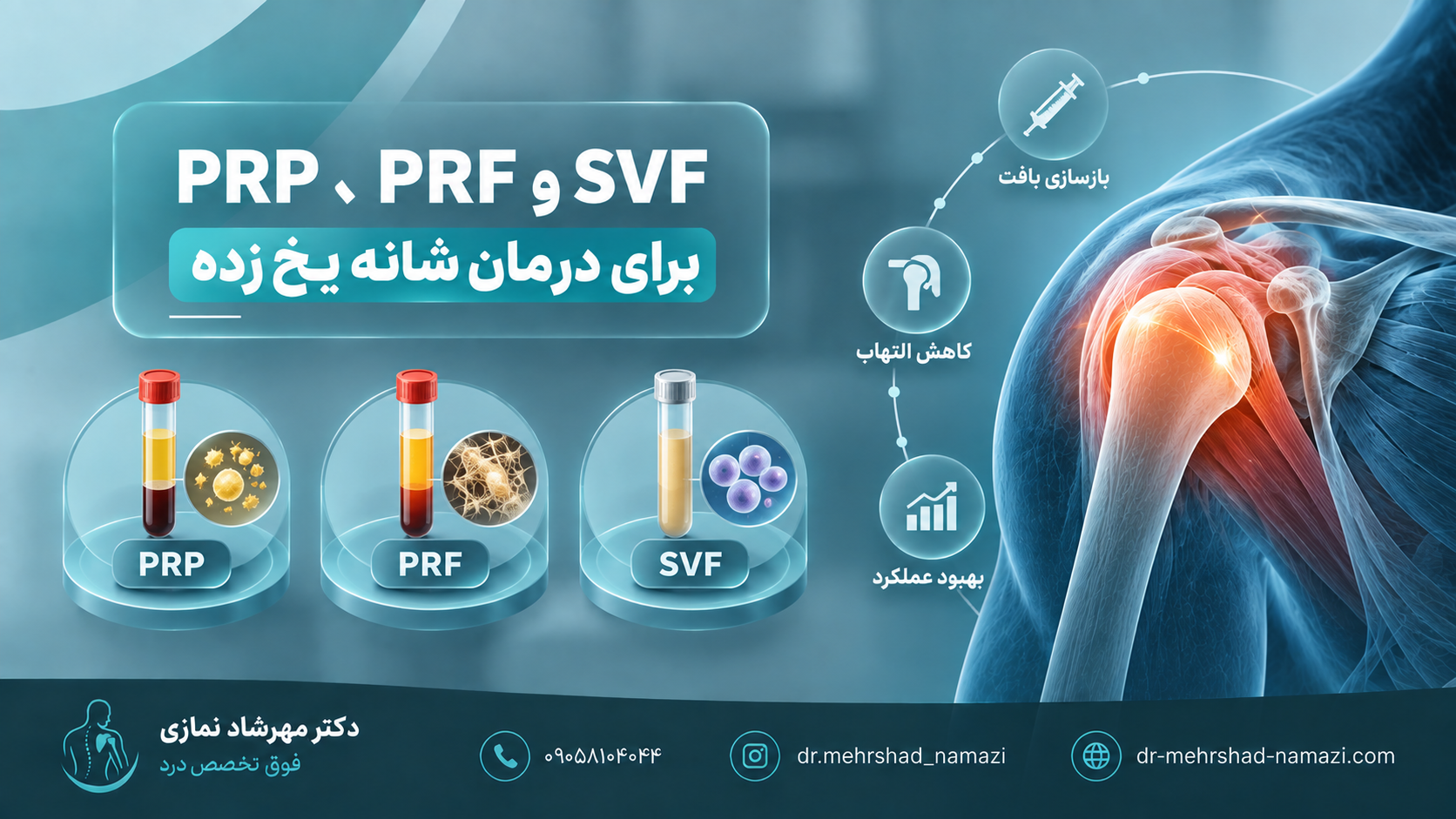PRP، PRF و SVF برای درمان شانه یخ زده چه تفاوتی دارند؟